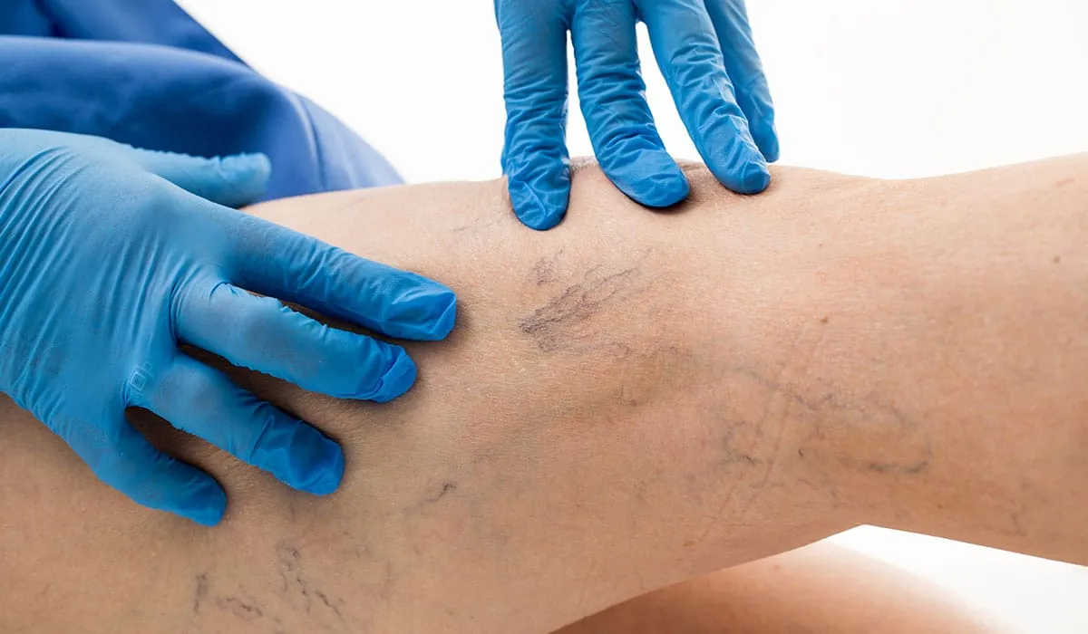 cuidado con la trombosis venosa profunda