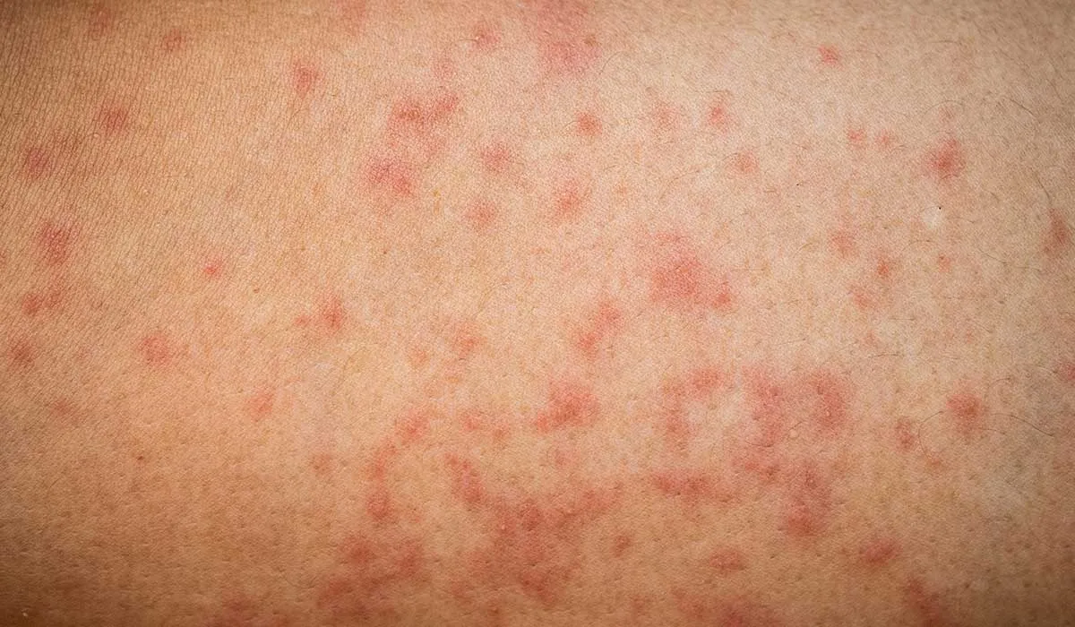 el invierno aumenta las imperfecciones en la piel