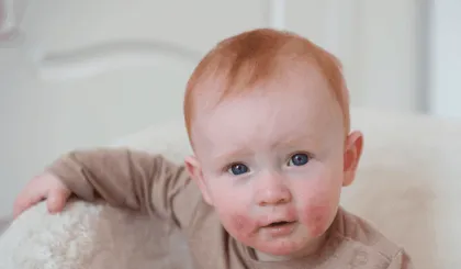 Dermatitis atópica