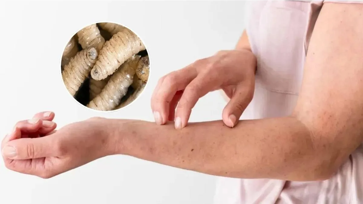 Alerta sanitaria: primer caso humano de “gusano barrenador” detectado en EE. UU.