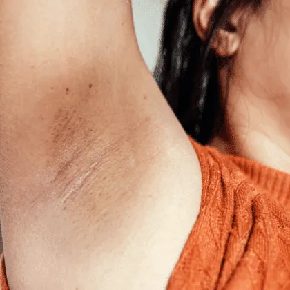 manchas oscuras en las axilas